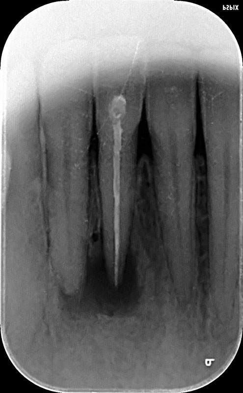 Caries 1