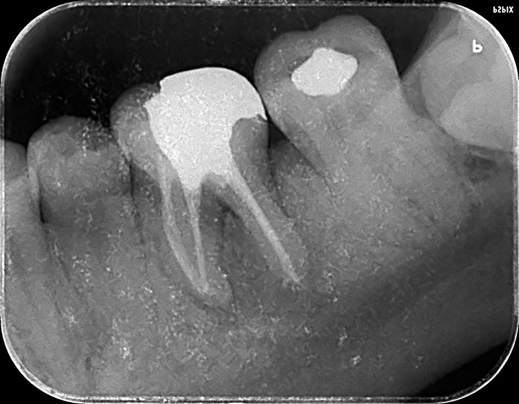 Caries 2